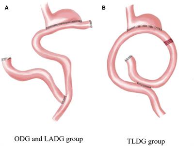 Effects of different radical distal gastrectomy on postoperative inflammatory response and nutritional status in patients with gastric cancer